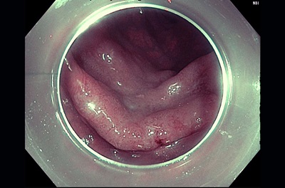 Transverse Colon ESD Lesion